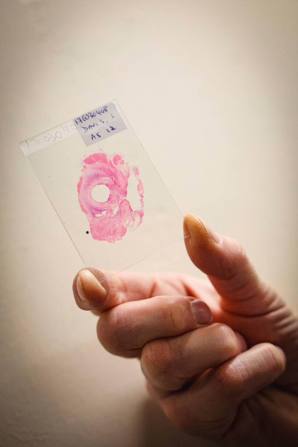 Researchers hope that examining the samples and cross-sections from their bowel cancer archive over the decades will help determine increasing numbers of younger people worldwide are being diagnosed